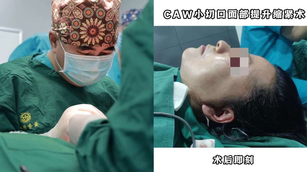 54岁拉皮手术后第四年,这样的效果值吗?真实反馈大曝光...... 54岁拉皮手术后第四年,这样的效果值吗?真实反馈大曝光......