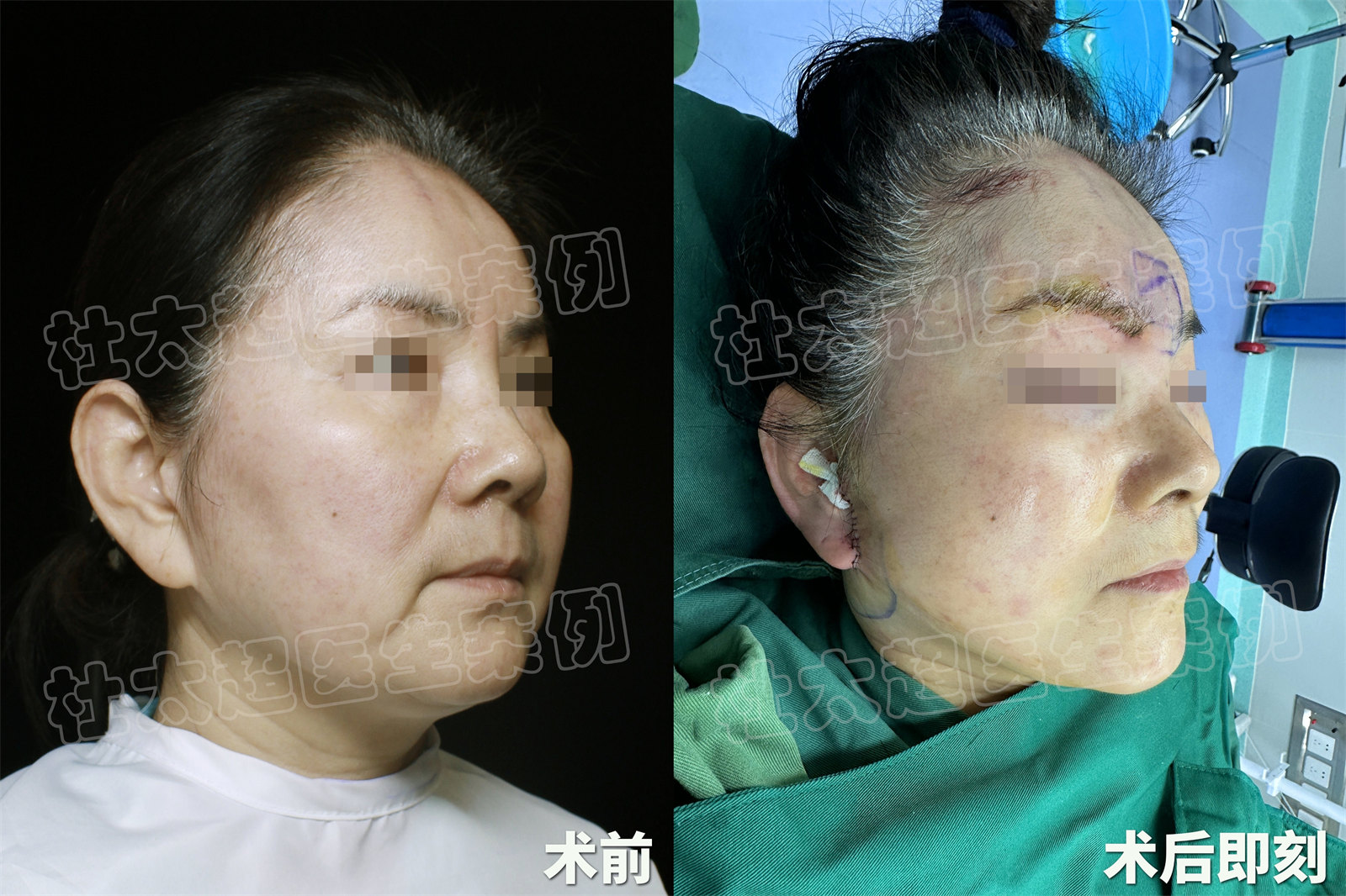 拉皮术后即刻竟然变这样,具体手术方案公开 拉皮术后即刻竟然变这样,具体手术方案公开