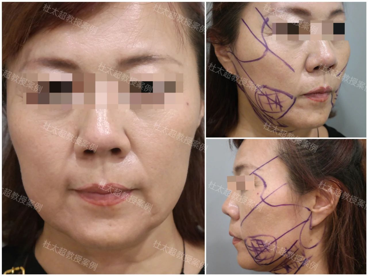 孤注一掷?56岁来做拉皮手术,是她最后的赌注还是自我救赎? 孤注一掷?56岁来做拉皮手术,是她最后的赌注还是自我救赎?