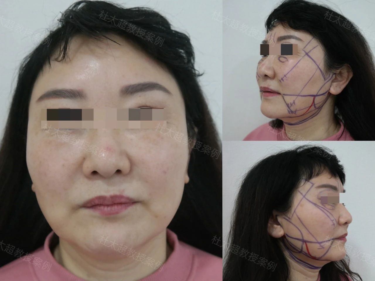 56岁姐姐做拉皮手术过程全公开!这样的效果也是你想要的吗? 56岁姐姐做拉皮手术过程全公开!这样的效果也是你想要的吗?