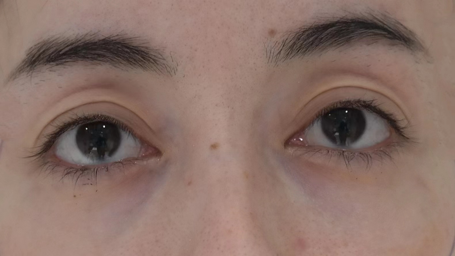 29岁求美者切眉术后恢复过程记录,真实分享 29岁求美者切眉术后恢复过程记录,真实分享