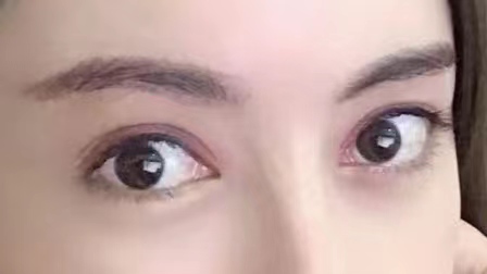 29岁求美者切眉术后恢复过程记录,真实分享 29岁求美者切眉术后恢复过程记录,真实分享