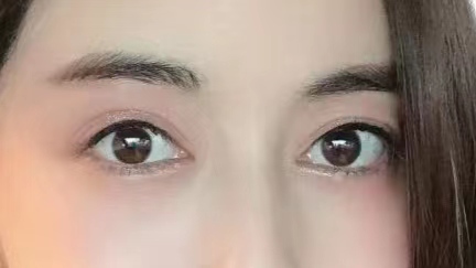 29岁求美者切眉术后恢复过程记录,真实分享 29岁求美者切眉术后恢复过程记录,真实分享