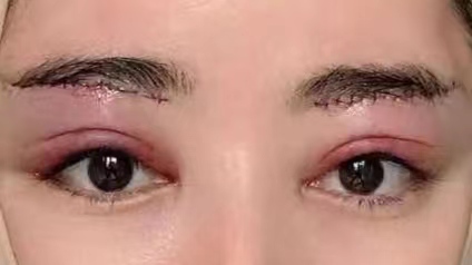 29岁求美者切眉术后恢复过程记录,真实分享 29岁求美者切眉术后恢复过程记录,真实分享