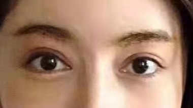 29岁求美者切眉术后恢复过程记录,真实分享 29岁求美者切眉术后恢复过程记录,真实分享