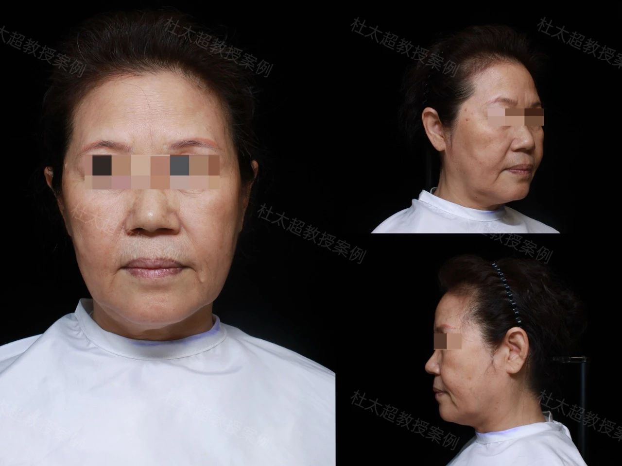 60岁求美者caw小切口面部提升缩紧术后深度分析 60岁求美者caw小切口面部提升缩紧术后深度分析