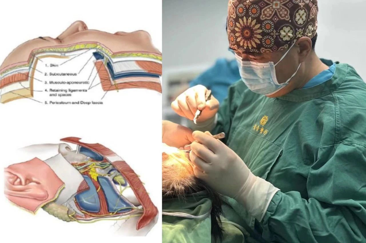 60岁求美者caw小切口面部提升缩紧术后深度分析 60岁求美者caw小切口面部提升缩紧术后深度分析