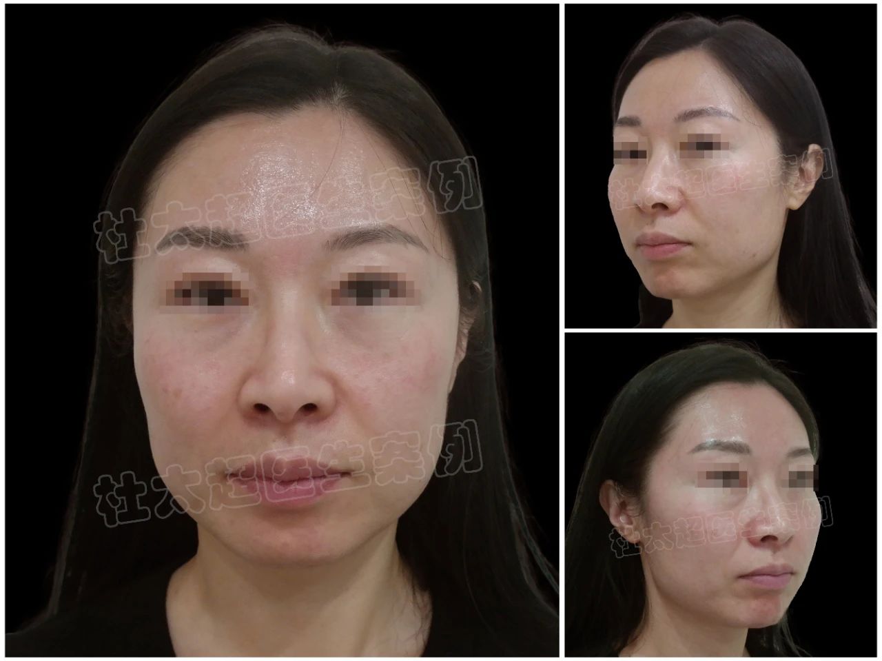 时光见证的美丽奇迹:40+女士caw小切口面部提升缩紧术后8年的深度剖析 时光见证的美丽奇迹:40+女士caw小切口面部提升缩紧术后8年的深度剖析