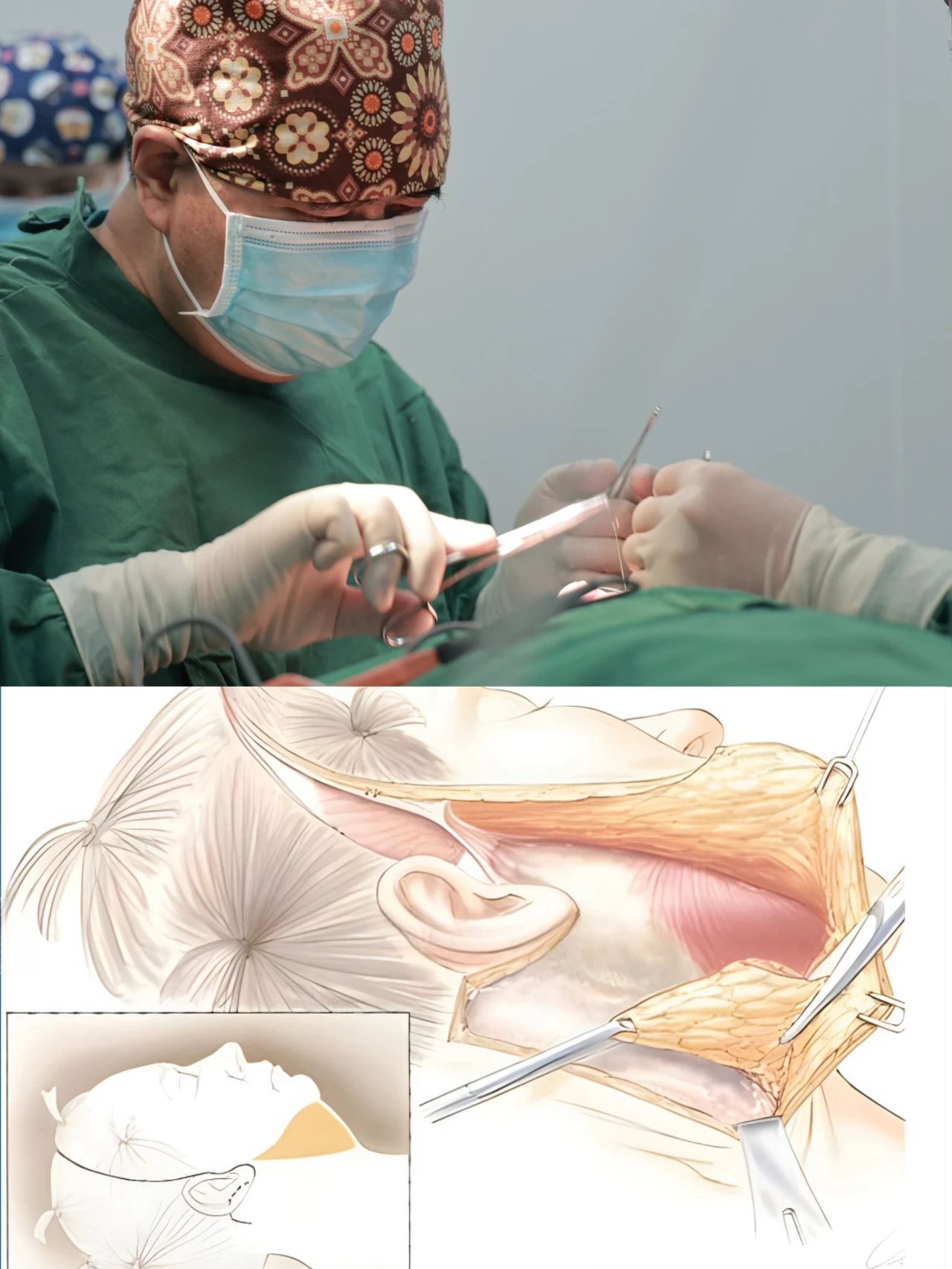 时光见证的美丽奇迹:40+女士caw小切口面部提升缩紧术后8年的深度剖析 时光见证的美丽奇迹:40+女士caw小切口面部提升缩紧术后8年的深度剖析