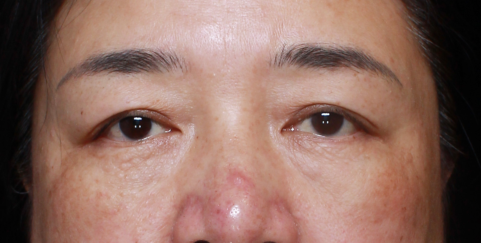 47岁大姐挑战眼周年轻化,术后40天,年轻了好多! 47岁大姐挑战眼周年轻化,术后40天,年轻了好多!