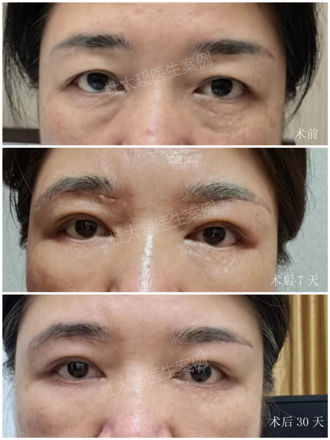 47岁大姐挑战眼周年轻化,术后40天,年轻了好多! 47岁大姐挑战眼周年轻化,术后40天,年轻了好多!