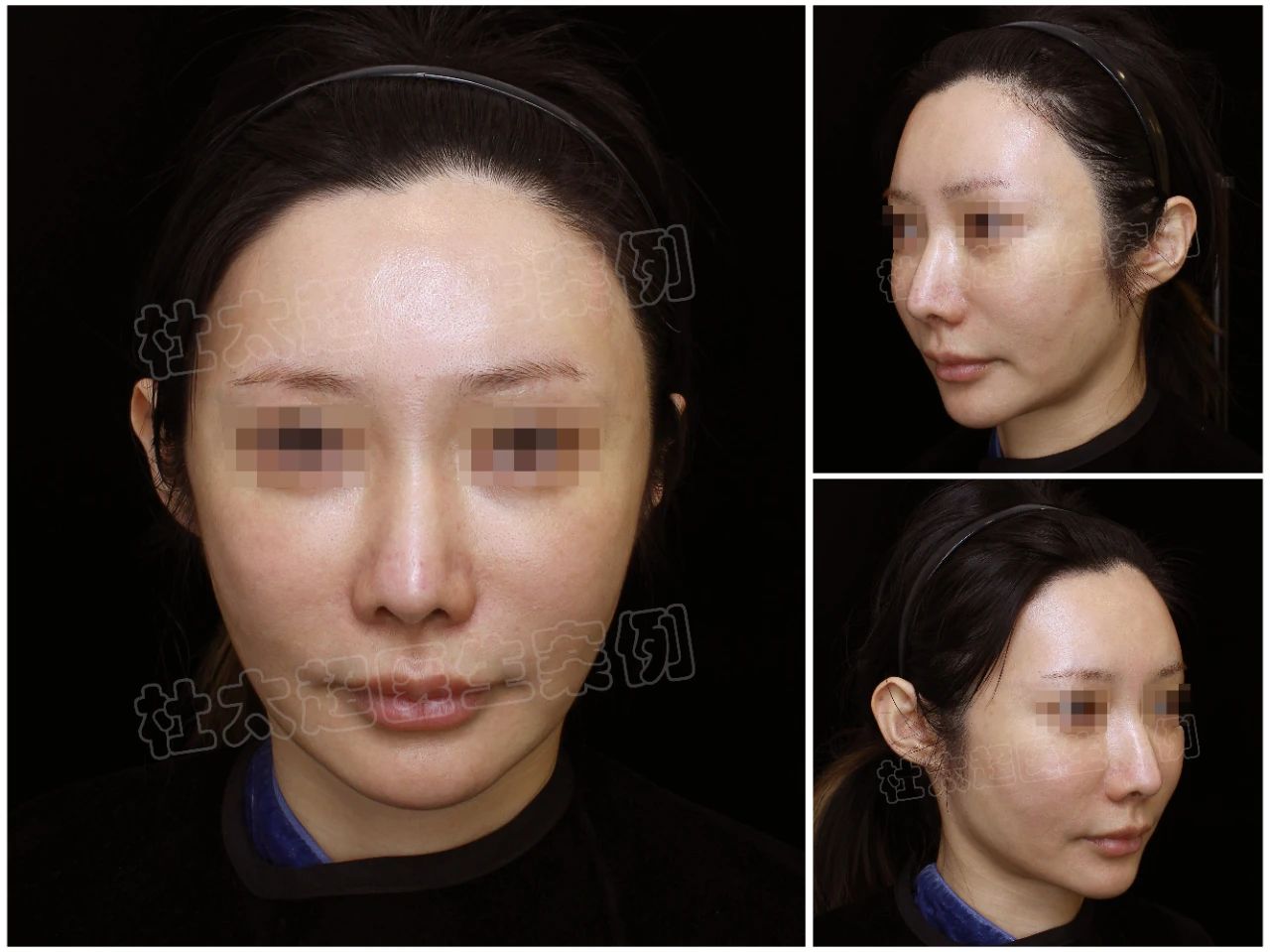 40岁大姐真心话:做拉皮手术,是真年轻了还是瞎折腾? 40岁大姐真心话:做拉皮手术,是真年轻了还是瞎折腾?