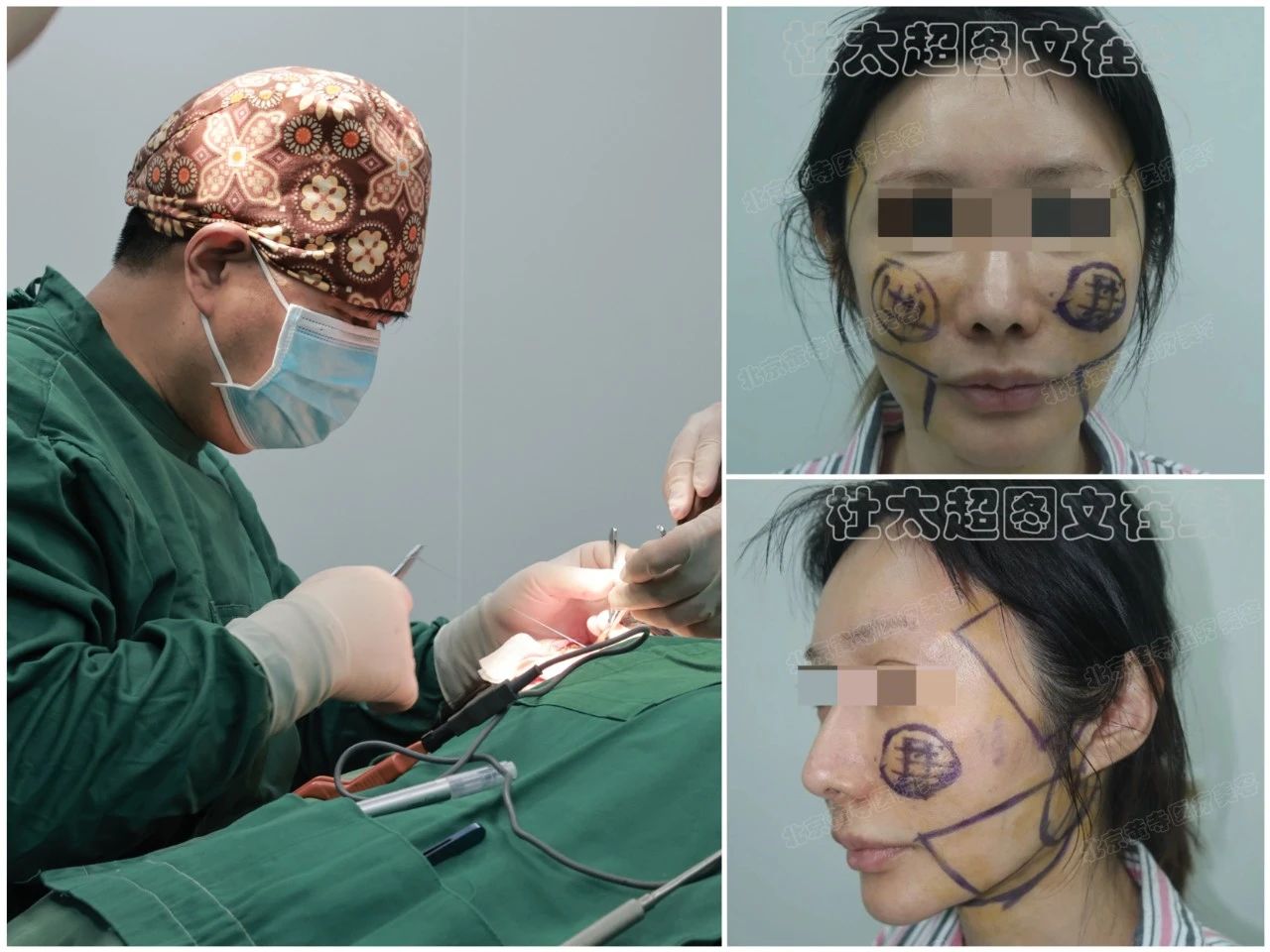 40岁大姐真心话:做拉皮手术,是真年轻了还是瞎折腾? 40岁大姐真心话:做拉皮手术,是真年轻了还是瞎折腾?