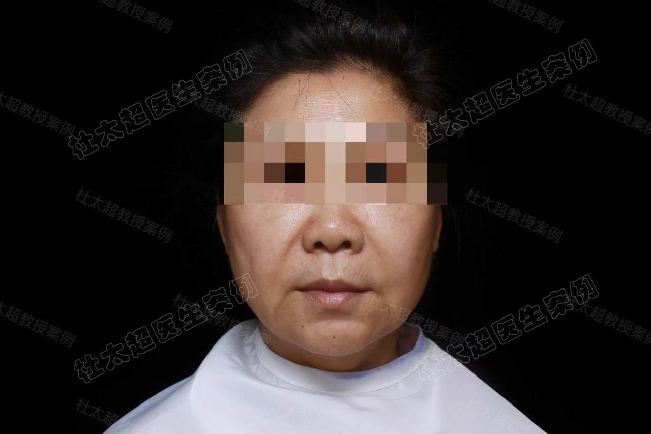 60岁深陷线雕漩涡,终于因为一次拉皮手术上岸 60岁深陷线雕漩涡,终于因为一次拉皮手术上岸