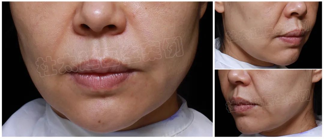 42岁求美者术后7天,拉皮手术是否过度追求年轻? 42岁求美者术后7天,拉皮手术是否过度追求年轻?