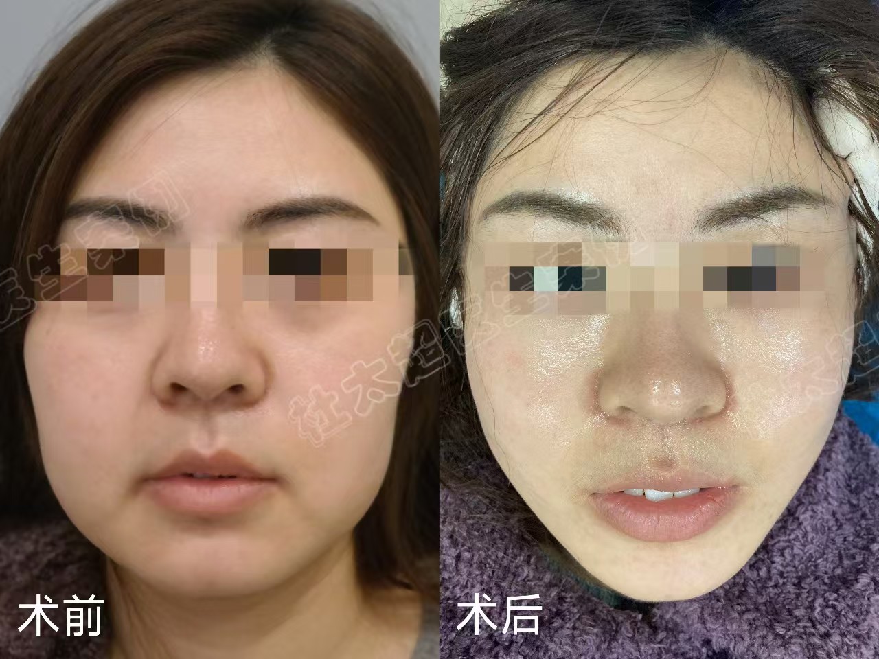 35岁做超声刀无效,转做拉皮,术后效果竟这样 35岁做超声刀无效,转做拉皮,术后效果竟这样