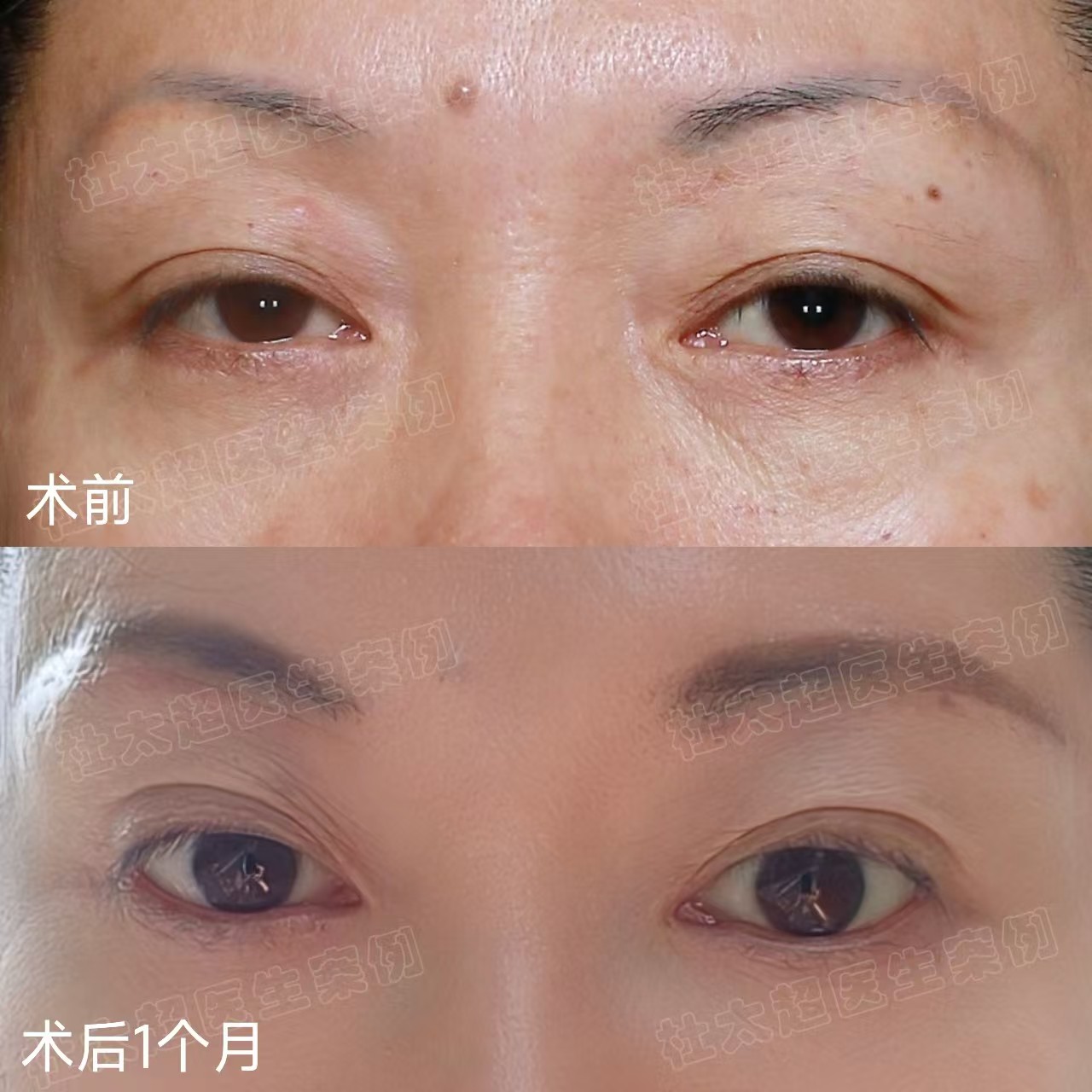 做完眼周年轻化术后1个月,忍不住分享手术心得 以下为求美者自述: 做眼周年轻化手术这件事,我想了很久,考虑了手术的利弊,最终还是决定搏一搏。 面诊时医生说我上下眼睑都存在衰老问题: 1、眼皮松弛明显,上眼睑皮肤松弛,睁眼无神。 2、下眼睑脂肪膨出 所以,医生综合我的基础帮我设计了手术方案:切眉手术+外切去眼袋。术后效果我很满意,所以想把我的手术心得分享给大家。 1、术前做好心理准备 术前了解的越多,手术时心里越有底,手术过程也就越放松。 2、不必纠结恢复期 任何手术都有恢复期,既然决定了要做手术改变,就不要再去纠结恢复期,保持好心情和良好的作息,基本上一天一个变化,一般7天拆线就已经消肿80%了,出门见人没有问题,之后就是切口痕迹逐渐淡化的问题了。 3、不要在意别人的眼光 别人的评价是暂时的,只有自己的成就是终身的。再说,现在手术年轻化很普遍,在群众中的接受度也非常高,所以,基本上身边很少有异样的眼光,相反,大家看到我的术后效果这么棒,都跃跃欲试,想要自己也改变一下。 所以,想做眼周年轻化手术就做吧,取悦自己有何不可呢? 做完眼周年轻化术后1个月,忍不住分享手术心得 以下为求美者自述: 做眼周年轻化手术这件事,我想了很久,考虑了手术的利弊,最终还是决定搏一搏。 面诊时医生说我上下眼睑都存在衰老问题: 1、眼皮松弛明显,上眼睑皮肤松弛,睁眼无神。 2、下眼睑脂肪膨出 所以,医生综合我的基础帮我设计了手术方案:切眉手术+外切去眼袋。术后效果我很满意,所以想把我的手术心得分享给大家。 1、术前做好心理准备 术前了解的越多,手术时心里越有底,手术过程也就越放松。 2、不必纠结恢复期 任何手术都有恢复期,既然决定了要做手术改变,就不要再去纠结恢复期,保持好心情和良好的作息,基本上一天一个变化,一般7天拆线就已经消肿80%了,出门见人没有问题,之后就是切口痕迹逐渐淡化的问题了。 3、不要在意别人的眼光 别人的评价是暂时的,只有自己的成就是终身的。再说,现在手术年轻化很普遍,在群众中的接受度也非常高,所以,基本上身边很少有异样的眼光,相反,大家看到我的术后效果这么棒,都跃跃欲试,想要自己也改变一下。 所以,想做眼周年轻化手术就做吧,取悦自己有何不可呢?