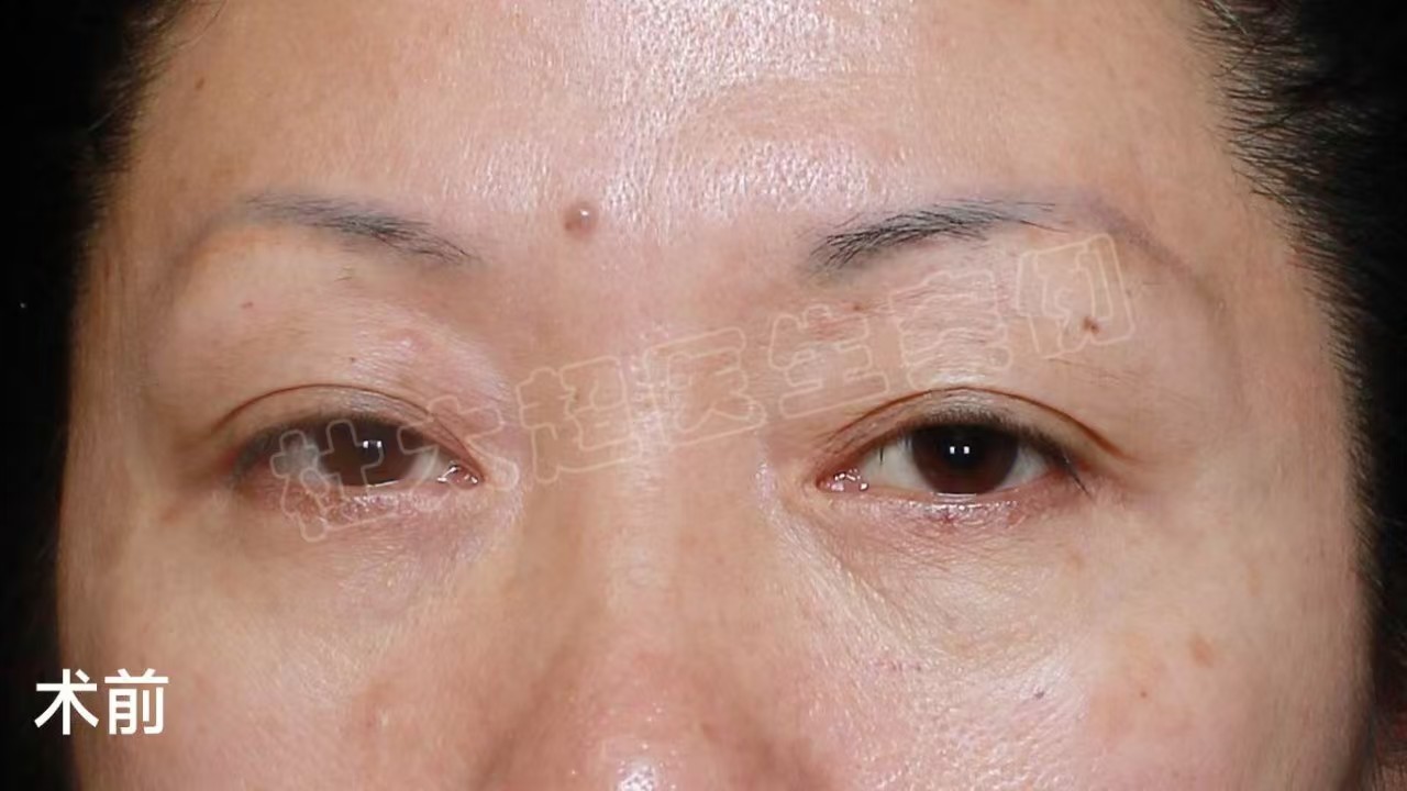 做完眼周年轻化术后1个月,忍不住分享手术心得 以下为求美者自述: 做眼周年轻化手术这件事,我想了很久,考虑了手术的利弊,最终还是决定搏一搏。 面诊时医生说我上下眼睑都存在衰老问题: 1、眼皮松弛明显,上眼睑皮肤松弛,睁眼无神。 2、下眼睑脂肪膨出 所以,医生综合我的基础帮我设计了手术方案:切眉手术+外切去眼袋。术后效果我很满意,所以想把我的手术心得分享给大家。 1、术前做好心理准备 术前了解的越多,手术时心里越有底,手术过程也就越放松。 2、不必纠结恢复期 任何手术都有恢复期,既然决定了要做手术改变,就不要再去纠结恢复期,保持好心情和良好的作息,基本上一天一个变化,一般7天拆线就已经消肿80%了,出门见人没有问题,之后就是切口痕迹逐渐淡化的问题了。 3、不要在意别人的眼光 别人的评价是暂时的,只有自己的成就是终身的。再说,现在手术年轻化很普遍,在群众中的接受度也非常高,所以,基本上身边很少有异样的眼光,相反,大家看到我的术后效果这么棒,都跃跃欲试,想要自己也改变一下。 所以,想做眼周年轻化手术就做吧,取悦自己有何不可呢? 做完眼周年轻化术后1个月,忍不住分享手术心得 以下为求美者自述: 做眼周年轻化手术这件事,我想了很久,考虑了手术的利弊,最终还是决定搏一搏。 面诊时医生说我上下眼睑都存在衰老问题: 1、眼皮松弛明显,上眼睑皮肤松弛,睁眼无神。 2、下眼睑脂肪膨出 所以,医生综合我的基础帮我设计了手术方案:切眉手术+外切去眼袋。术后效果我很满意,所以想把我的手术心得分享给大家。 1、术前做好心理准备 术前了解的越多,手术时心里越有底,手术过程也就越放松。 2、不必纠结恢复期 任何手术都有恢复期,既然决定了要做手术改变,就不要再去纠结恢复期,保持好心情和良好的作息,基本上一天一个变化,一般7天拆线就已经消肿80%了,出门见人没有问题,之后就是切口痕迹逐渐淡化的问题了。 3、不要在意别人的眼光 别人的评价是暂时的,只有自己的成就是终身的。再说,现在手术年轻化很普遍,在群众中的接受度也非常高,所以,基本上身边很少有异样的眼光,相反,大家看到我的术后效果这么棒,都跃跃欲试,想要自己也改变一下。 所以,想做眼周年轻化手术就做吧,取悦自己有何不可呢?