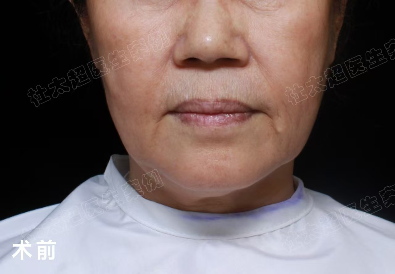 60岁姐姐挑战拉皮手术,术后3个月变得大不一样 60岁姐姐挑战拉皮手术,术后3个月变得大不一样