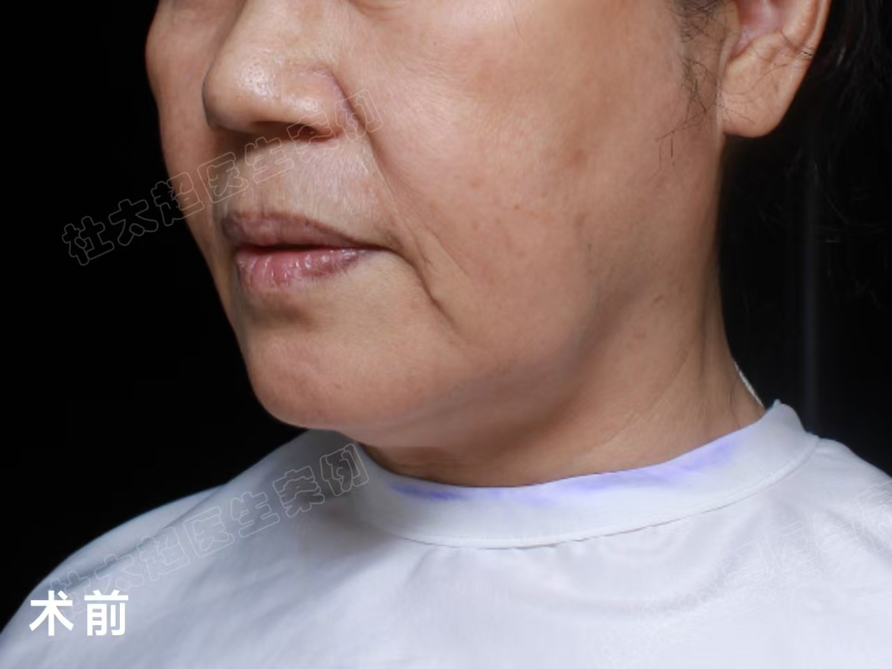 60岁姐姐挑战拉皮手术,术后3个月变得大不一样 60岁姐姐挑战拉皮手术,术后3个月变得大不一样