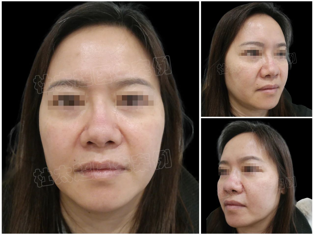 拉皮手术:40岁做还是50岁做?年龄争议再起 拉皮手术:40岁做还是50岁做?年龄争议再起