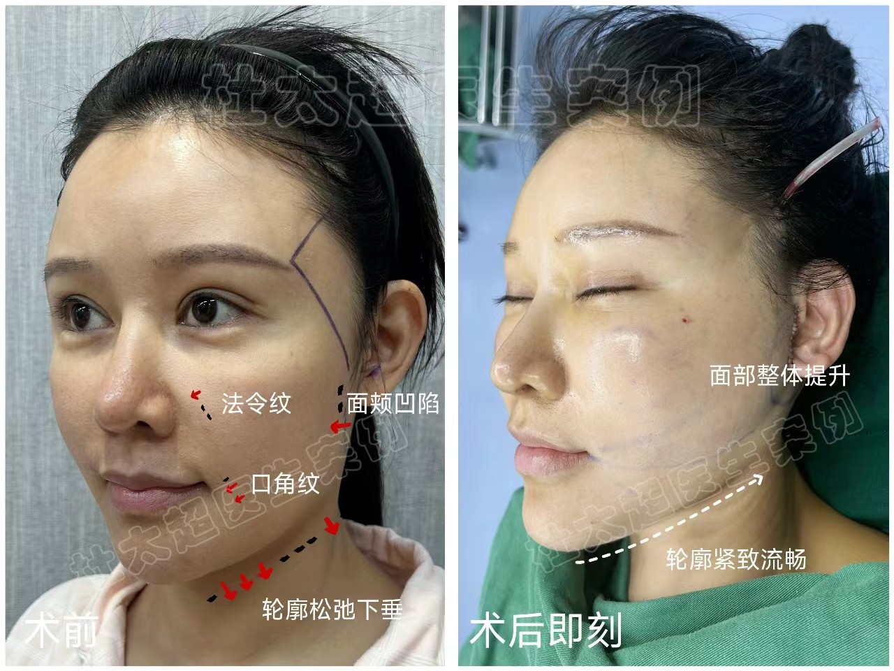 38岁女士追求美丽与青春,术后很惊艳,分享她的治疗方案 38岁女士追求美丽与青春,术后很惊艳,分享她的治疗方案