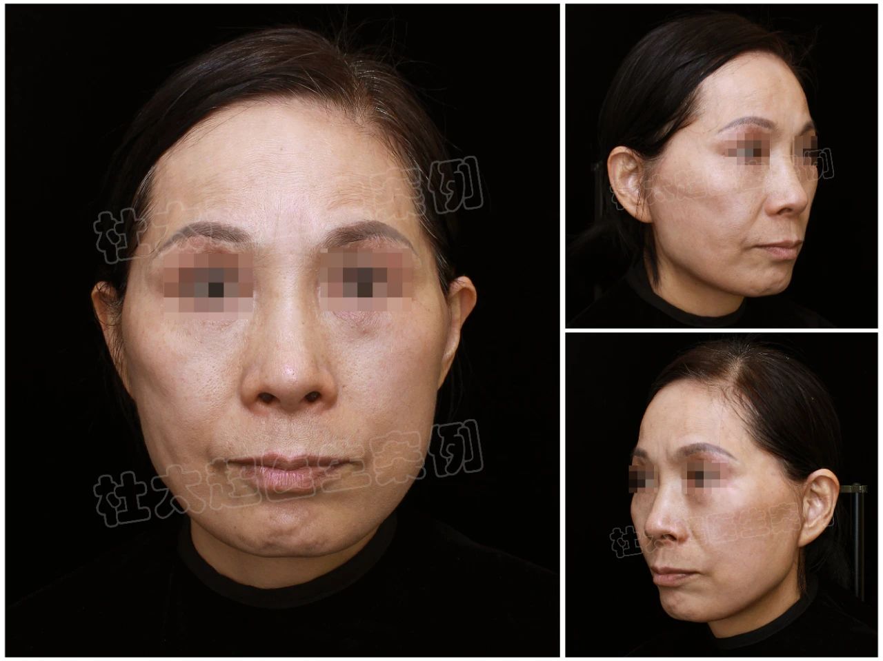 钱重要还是脸重要？57岁女士拉皮手术失败的血泪史！赶紧来看看吧...