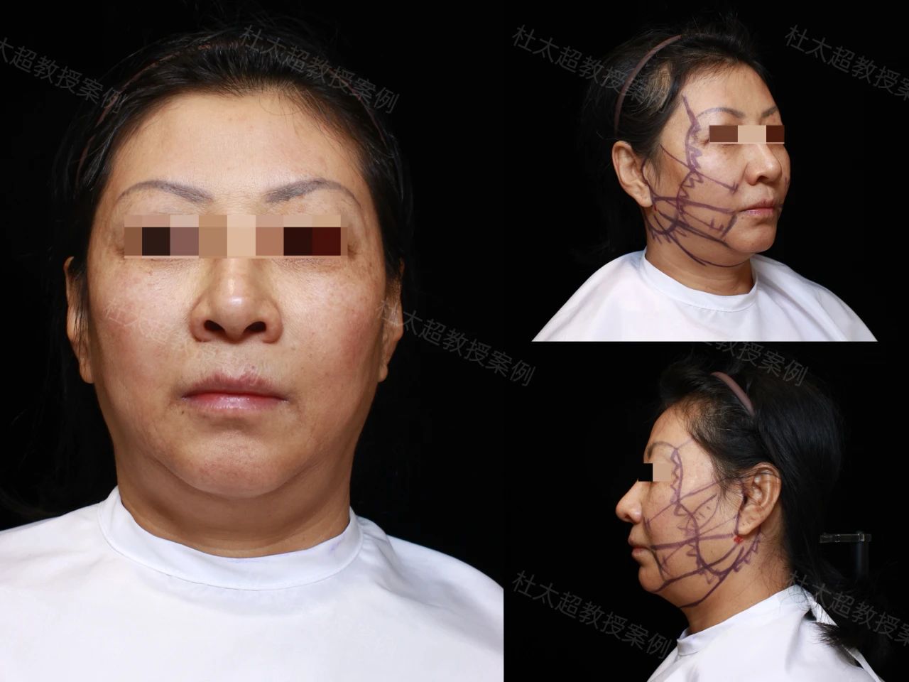 57岁大姐挑战拉皮手术,术后1个月 、3个月对比深度解析,这也是您所期待的样子吗? 57岁大姐挑战拉皮手术,术后1个月 、3个月对比深度解析,这也是您所期待的样子吗?