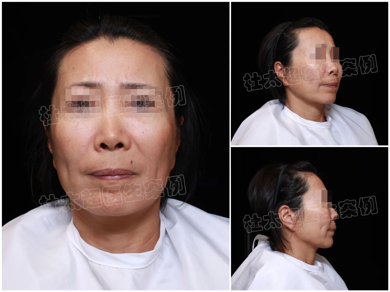 太震惊了!20年后,54岁的她再次选择拉皮手术,结果却在意料之外... 太震惊了!20年后,54岁的她再次选择拉皮手术,结果却在意料之外...