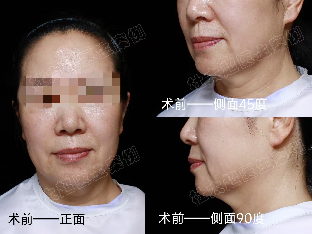 62岁忍不了“松垮垂”,决定做拉皮手术,术后即刻效果很惊艳! 62岁忍不了“松垮垂”,决定做拉皮手术,术后即刻效果很惊艳!