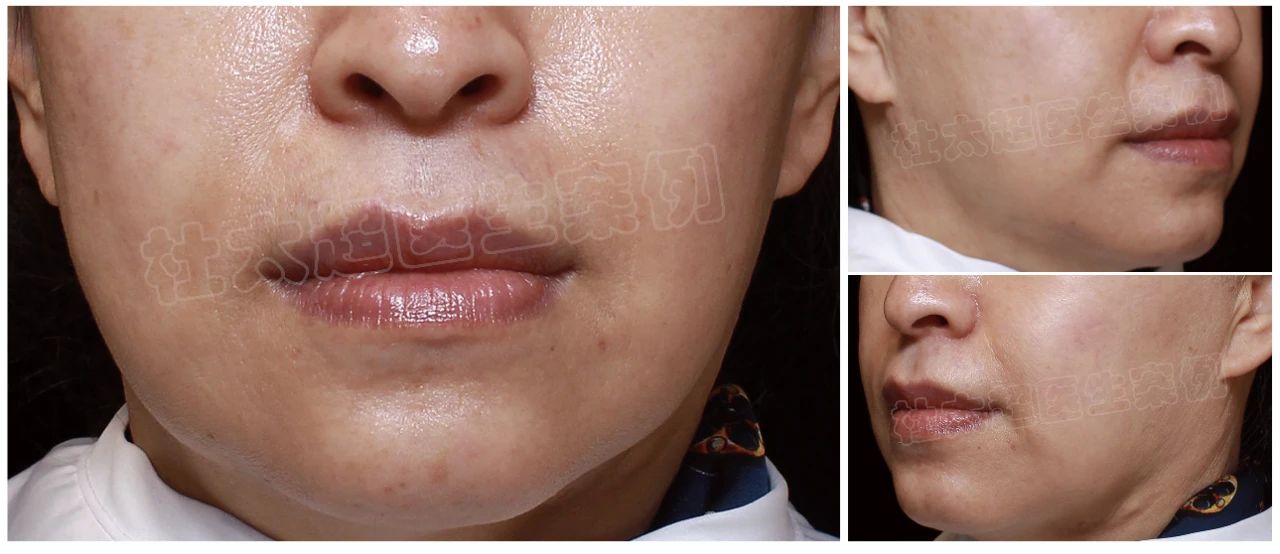 55岁教育工作者拉皮术后大变样，这效果，简直让人想问：咋这么惊艳呢？