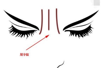 为什么有些人的川字纹，就像烙上去的？