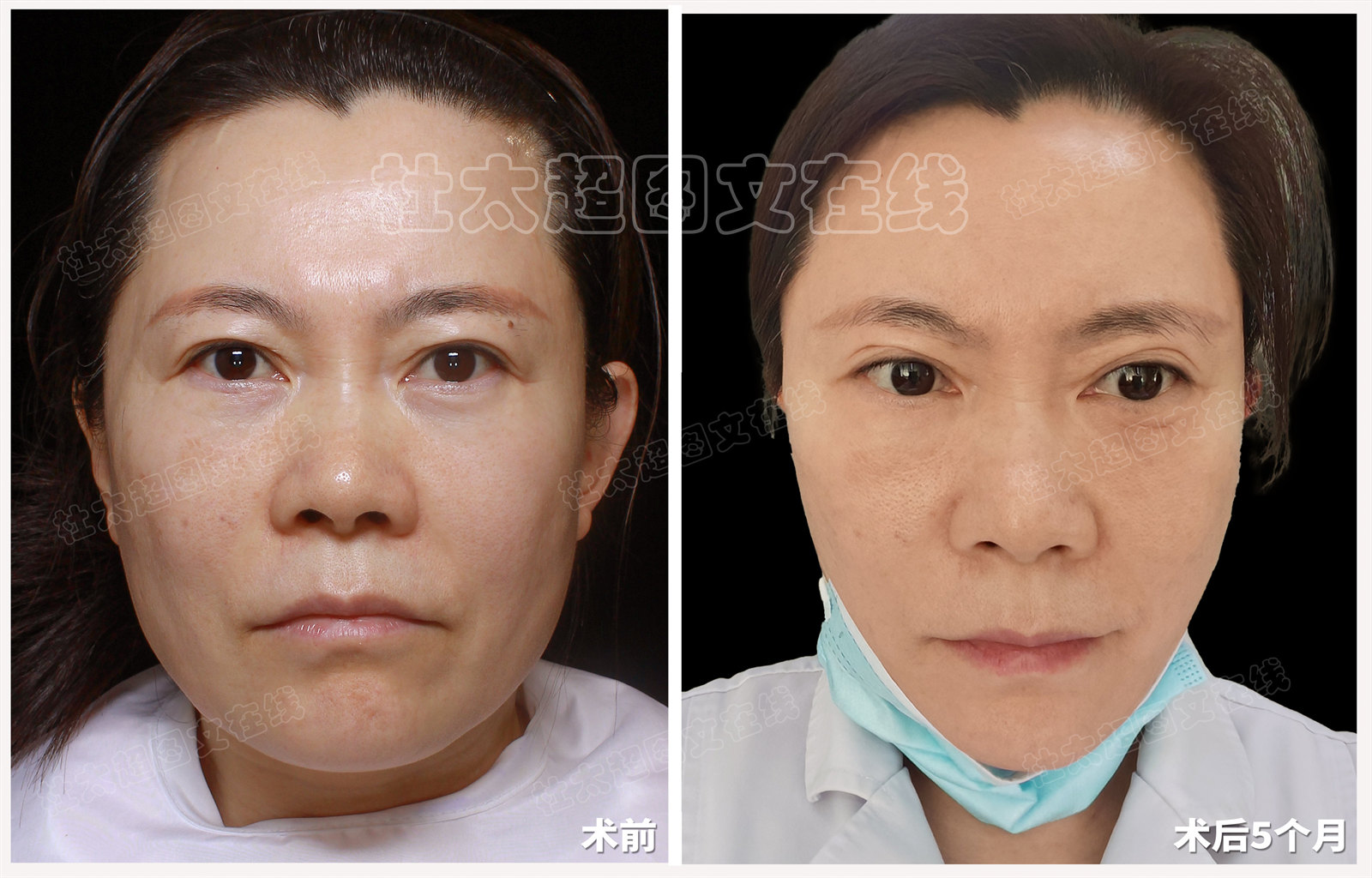 拉皮面部提升术后近期随访48天-年轻态