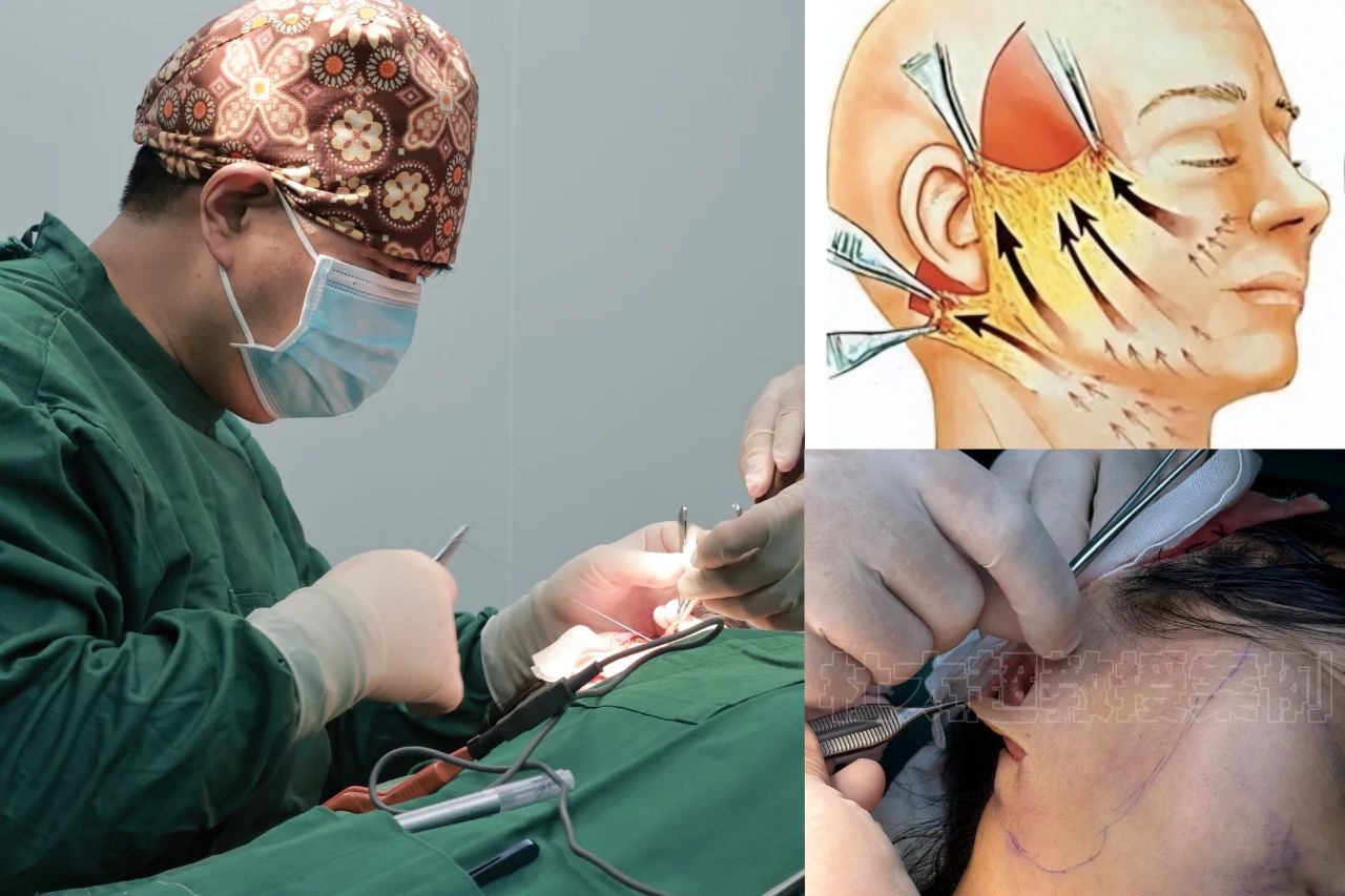 拉皮手术可不是“一刀切”那么简单,里头学问大着哦! 拉皮手术可不是“一刀切”那么简单,里头学问大着哦!