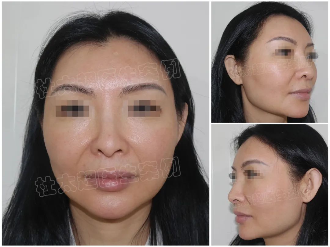 45岁求美者真情流露，为什么三年前会选择caw小切口面部提升缩紧术！