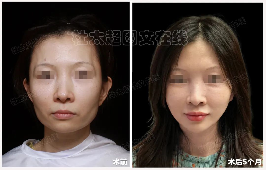 46岁的我放下成见做了拉皮手术,术后5个月:拉皮真香 46岁的我放下成见做了拉皮手术,术后5个月:拉皮真香