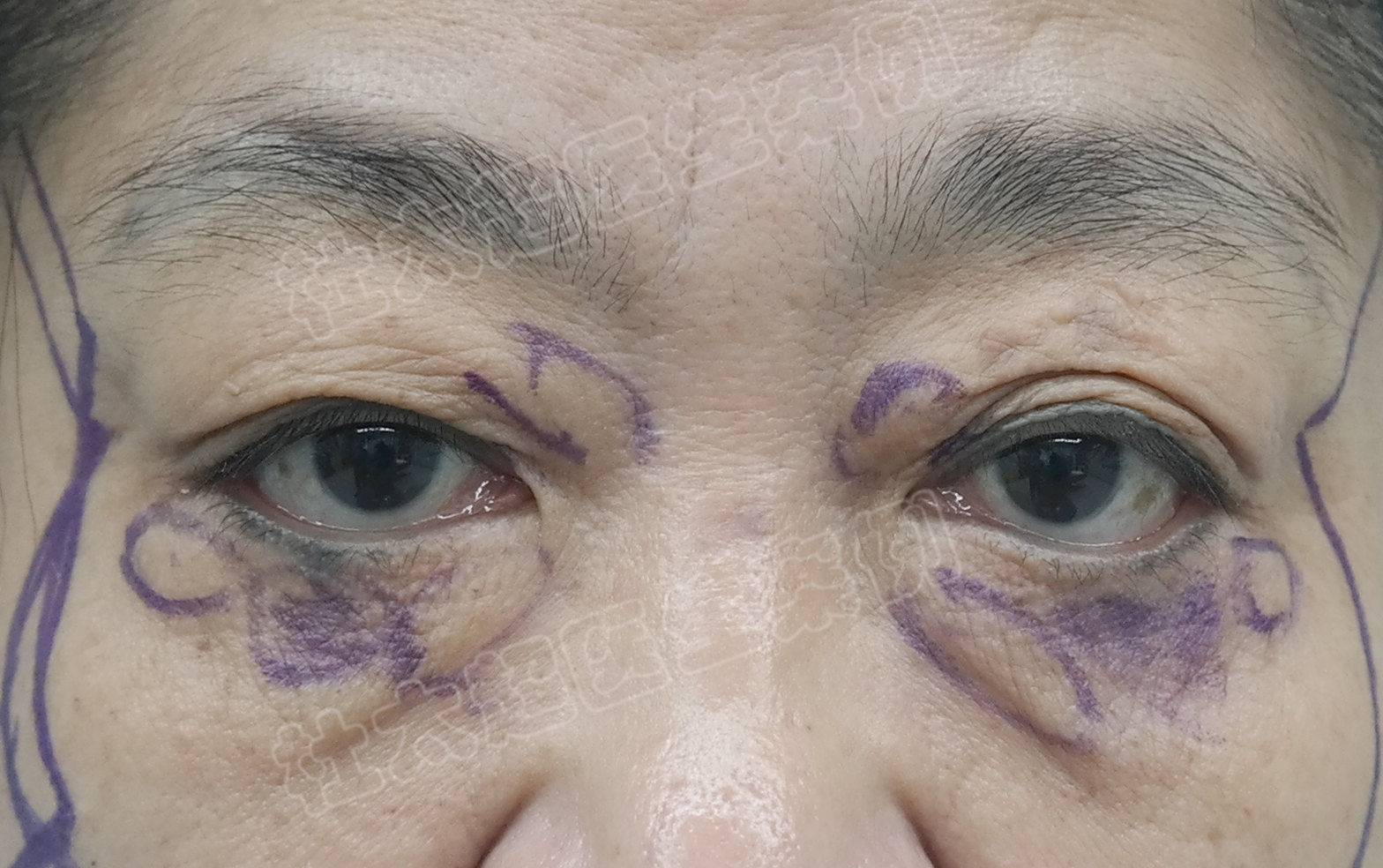 眼袋的钱花的太冤了，这次拉皮+眼袋修复，终于值了