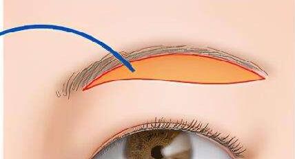 50岁眼皮松弛下垂最好的解决方法？