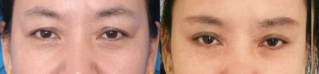 50岁眼皮松弛下垂最好的解决方法？