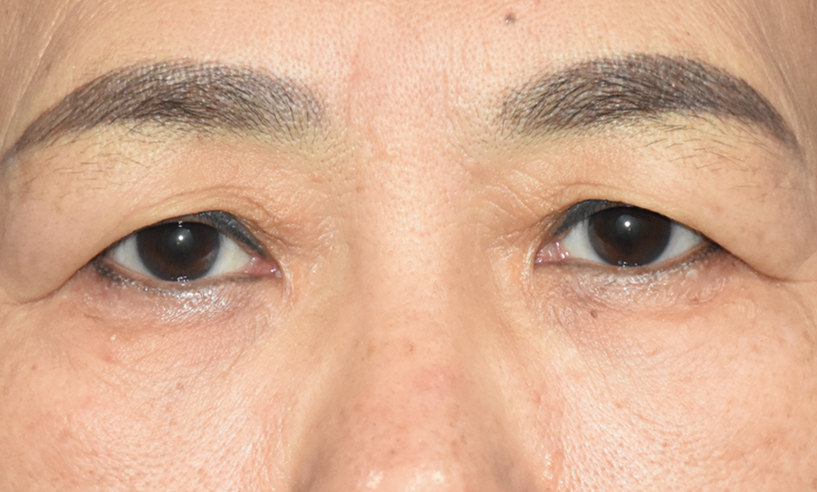 50岁眼皮松弛下垂最好的解决方法？