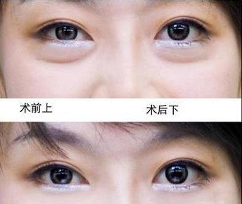 眼袋松弛下垂，如何有效解决？