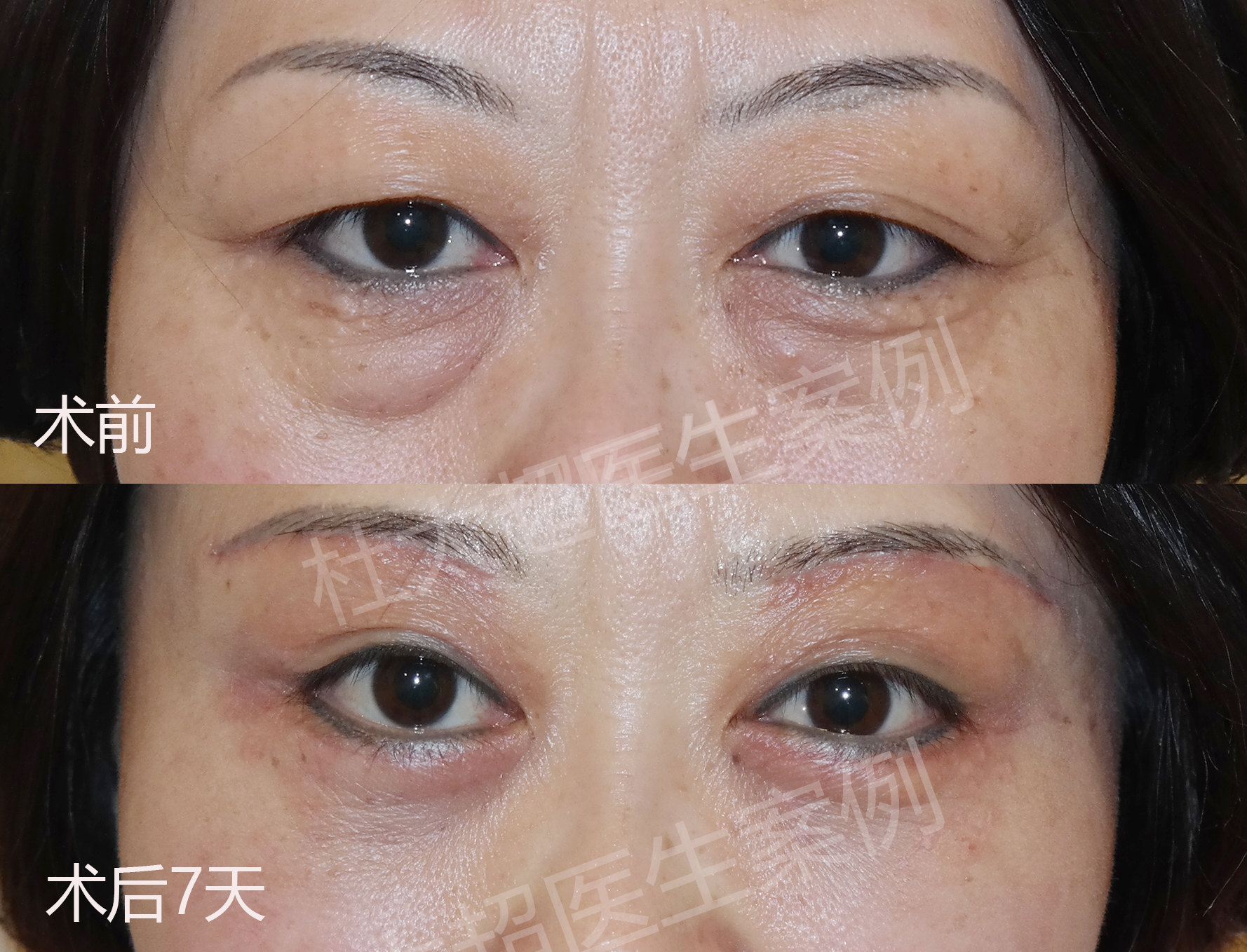 眼袋松弛下垂，如何有效解决？