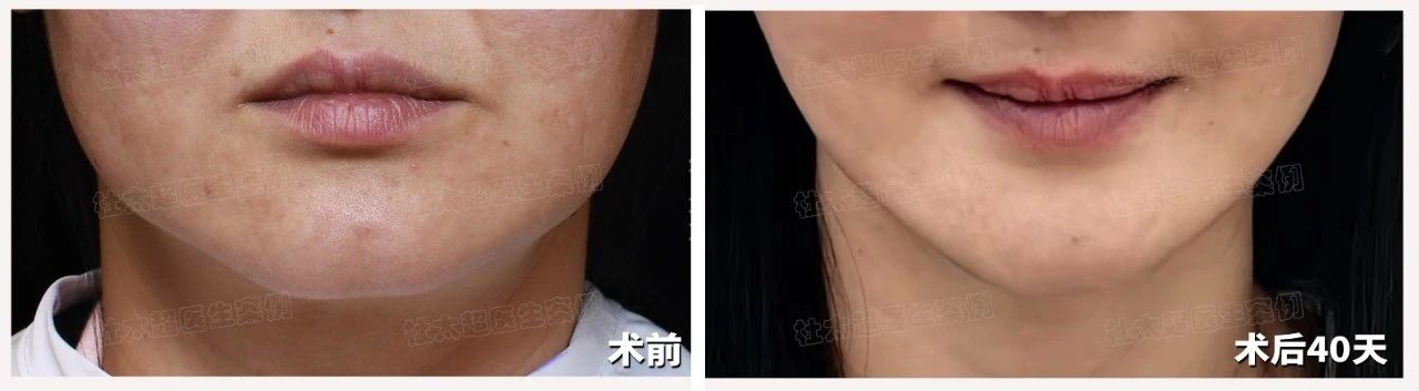 “偷感”整形的时代过去了，现在大家都......