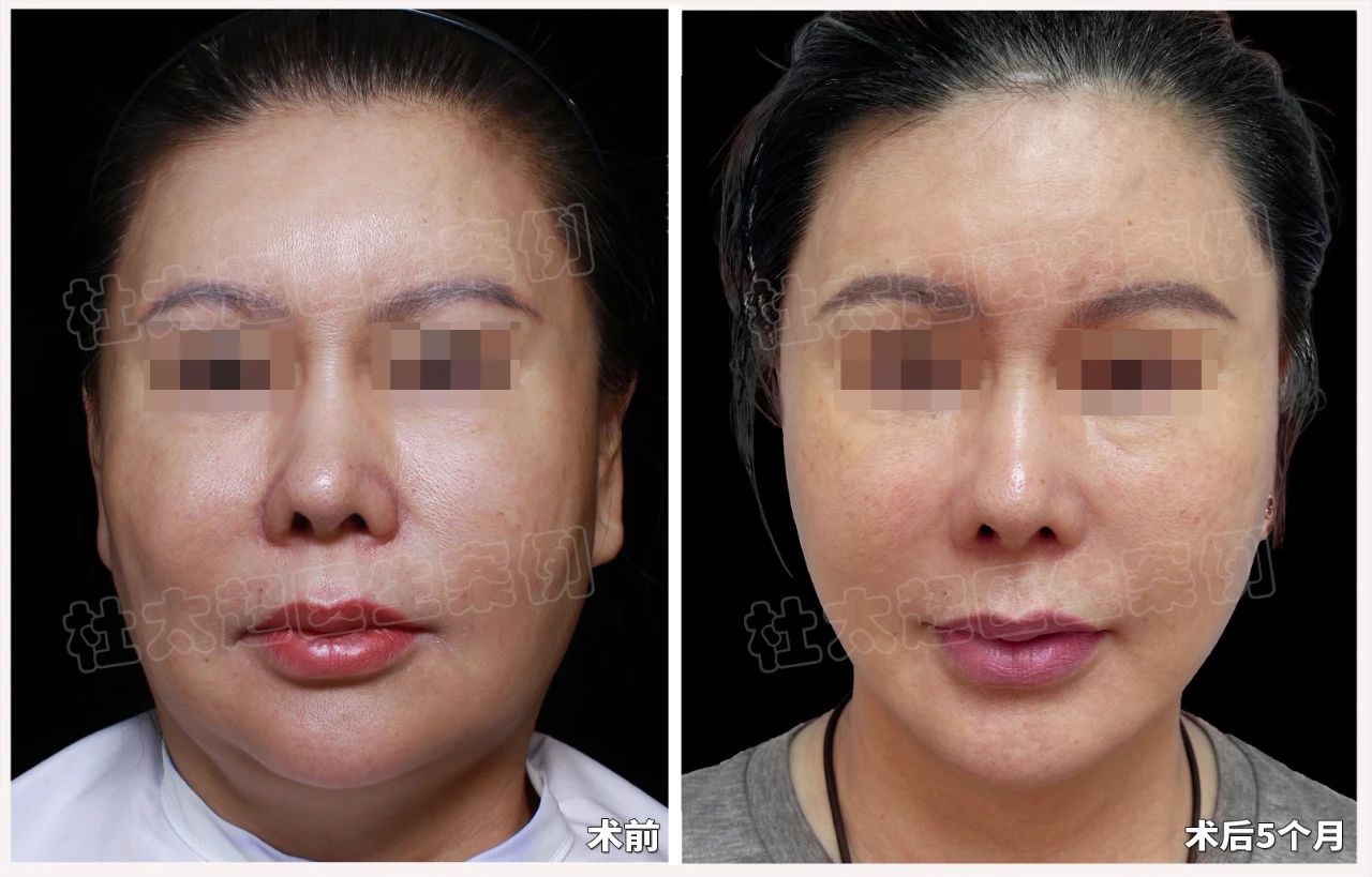 苹果肌也能“瘦身”？去掉“馒化”自然打造年轻态，caw技术为什么能成为时尚圈的新风尚？