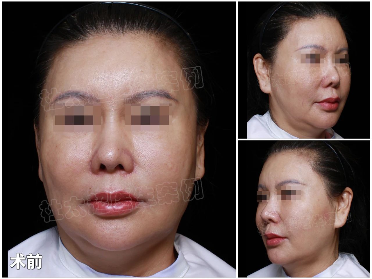 苹果肌也能“瘦身”？去掉“馒化”自然打造年轻态，caw技术为什么能成为时尚圈的新风尚？