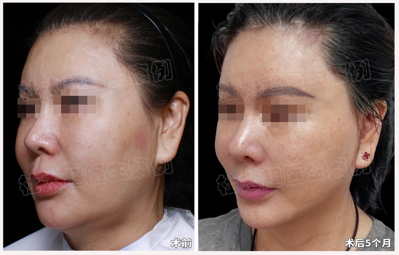 苹果肌也能“瘦身”？去掉“馒化”自然打造年轻态，caw技术为什么能成为时尚圈的新风尚？