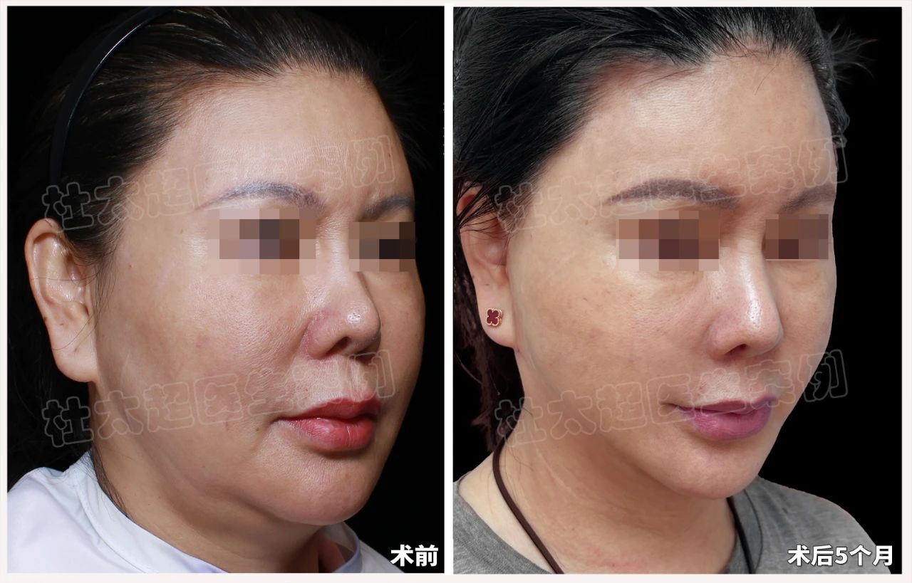 苹果肌也能“瘦身”？去掉“馒化”自然打造年轻态，caw技术为什么能成为时尚圈的新风尚？