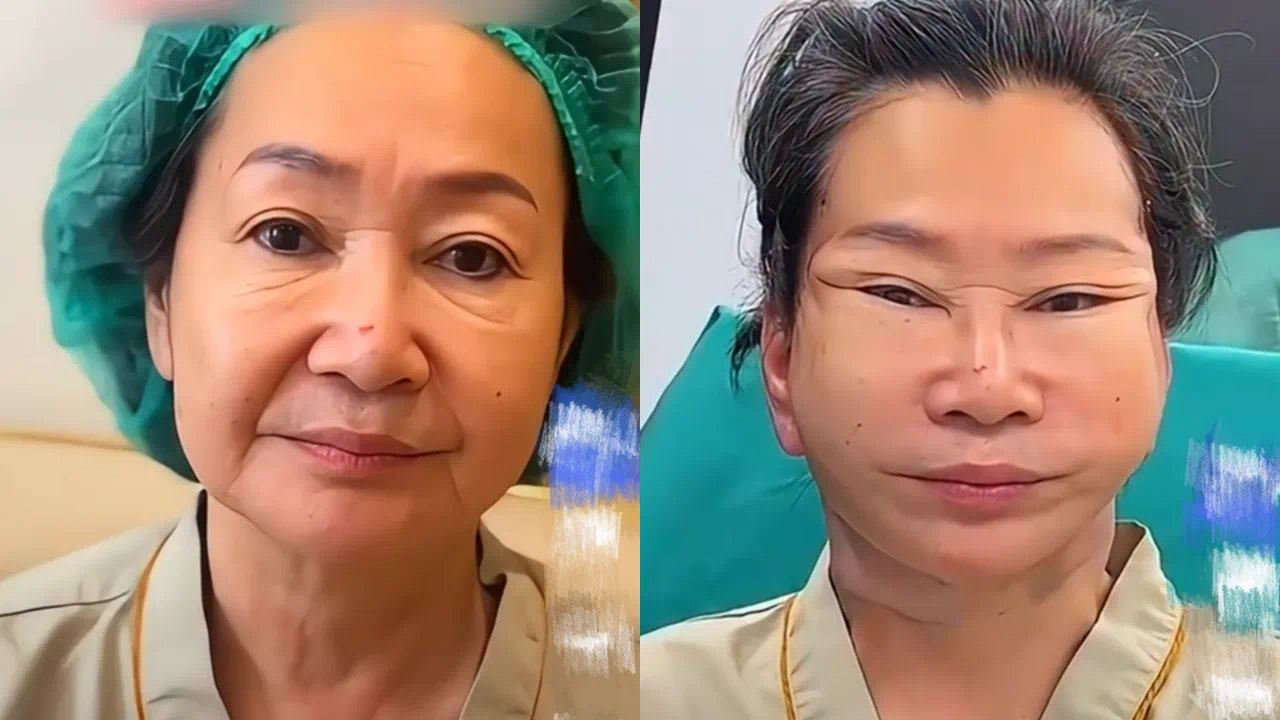 “灵魂出窍”拉皮术引热议，整形噩梦效果惊悚！正规面部提升术带您走出“拉皮误区”！