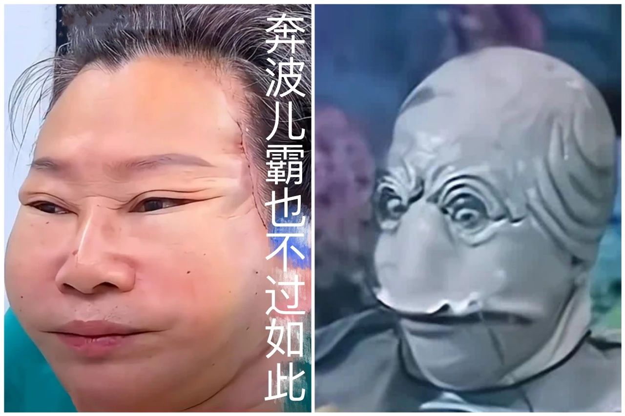 “灵魂出窍”拉皮术引热议，整形噩梦效果惊悚！正规面部提升术带您走出“拉皮误区”！