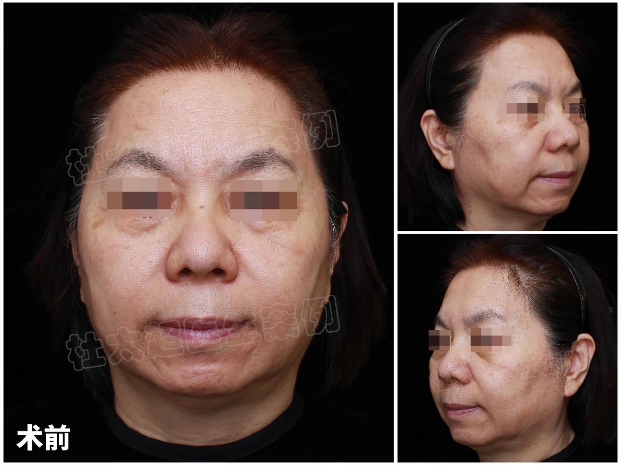 这种拉皮手术效果如此惊艳？！连切口都“隐身”了！60岁阿妈术后年龄成谜！